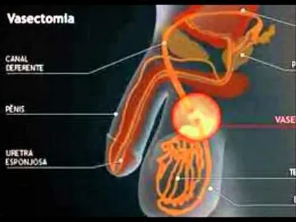 Vasectomy and Testicular Vascular Dysregulation
